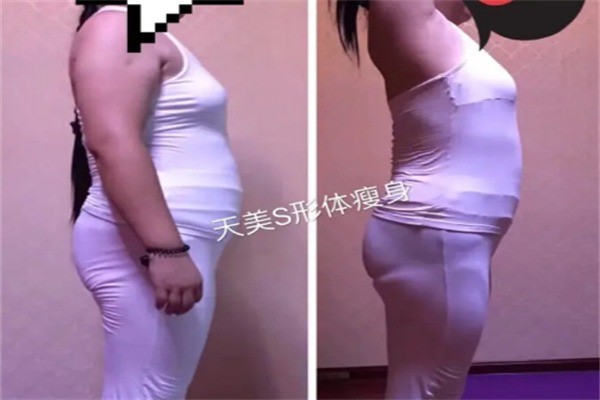 天美瘦身